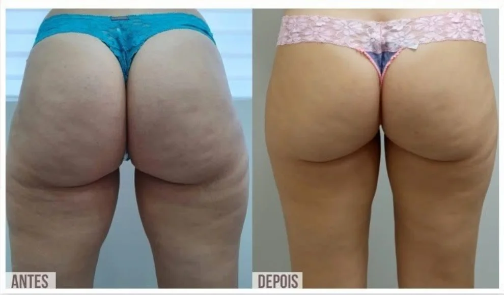 Antes e depois real na aparência da celulite com Lipo.Celulite GoPure